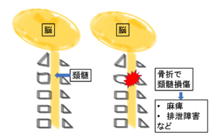 脊髄損傷